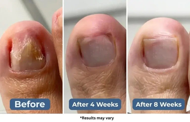Nail evolution showing progressive healing with FungaBeam treatment